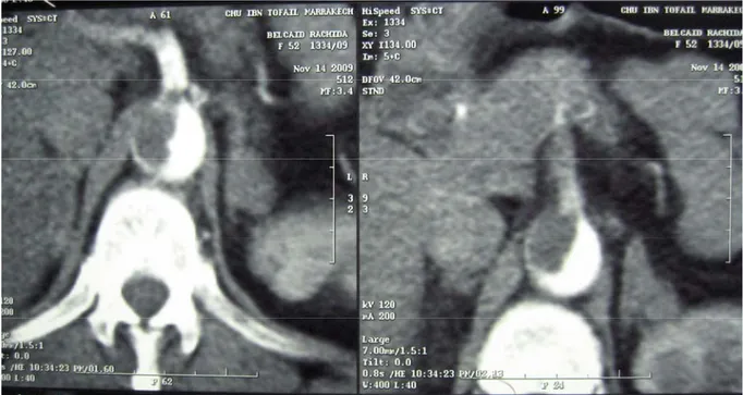 Figure 16 : Angioscanner abdominal montrant un thrombus pariétal de l’Aorte abdominal avec  extension au tonc ceoliaque 