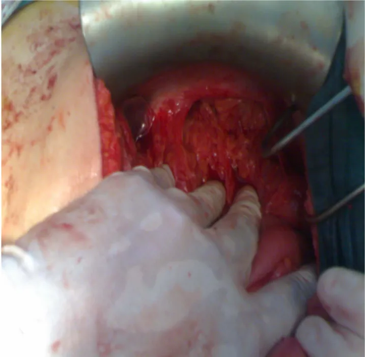 Figure 4 : Laparotomie médiane : rupture de la coupole gauche avec ascension de l'estomac 