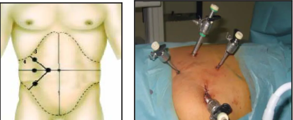 Figure 9 :  La position des trocarts, pour la chirurgie du haut  appareil   par  voie transpéritonéale