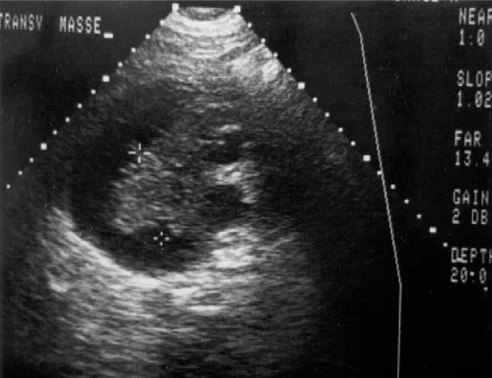 Figure 2 : masse rénale bien circonscrite 