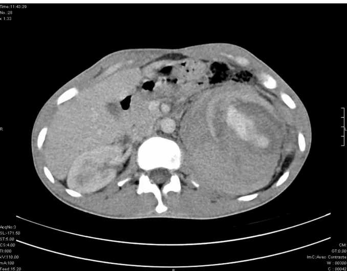 Figure 6 : Aspect TDM en faveur d’un processus tumoral polaire inférieur du rein gauche,  compliqué d’hémorragie, engendrant une effraction capsulaire et un hématome  spontané péri-rénal 