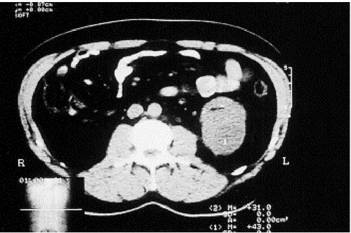 Figure 7 : Scanner sans injection de produit de contraste : Collection hypodense du pôle inférieur  du rein gauche 