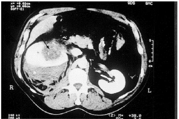 Figure 9 : Scanner avec injection de produit de contraste. Collection périrénale hypodense en  demi-lune et defect au sein de la néphrographie en rapport avec une tumeur parenchymateuse 