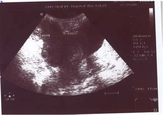Figure 3: Aspect  échographique d’une masse ovarienne solido-kystique pseudo  tumorale de l’ovaire droit