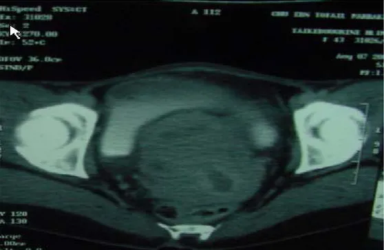 Figure 6: TDM montrant masse tumorale ovarienne mixte infiltrant  localement et envahissant l’utérus