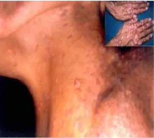 Figure 11: lésions pityriasis versicolor-like de la nuque, avec des verrues du cou et des dos des  mains [52]