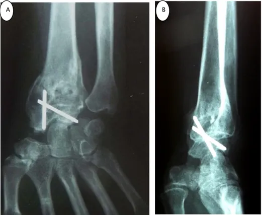 Figure 11 : Radiographie de contrôle, face (A) et profil (B),  montrant une fracture  comminutive du RD traitée par ARSL avec triquetrectomie et résection distale du scaphoïde 