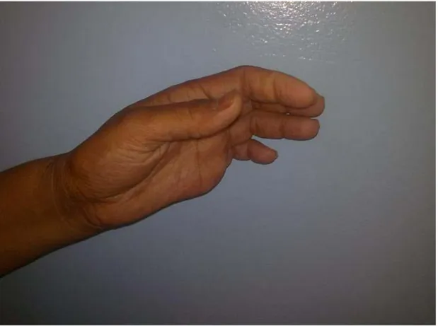 Figure 7 :Aspect de main d’accoucheur chez une patiente opérée d’un goitre,et dont le  geste chirurgical a consisté en une thyroidectomie totale