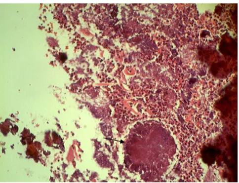Figure 7 : Aspect au microscope optique (×100) avec coloration PAS de grain       actinomycosique au sein d'un infiltrat inflammatoire polymorphe