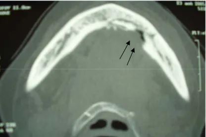Figure 9: Aspect tomodensitométrique: aspect d'ostéite intéressant le tiers antérieur de la  mandibule