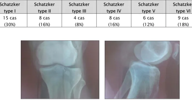 Tableau III : répartition de la série selon la classification de Schatzker. 