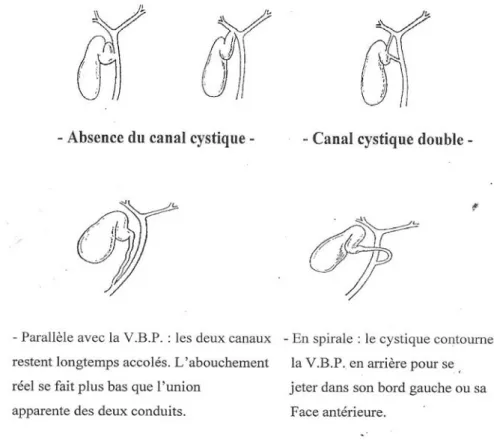 Figure 11 : variations anatomiques du canal  cystique (14) 