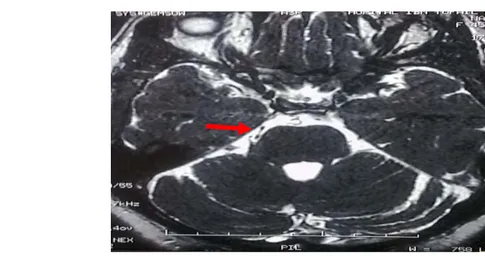 Figure 6 : IRM encéphalique en coupes axiales, et séquence T2 de haute résolution, montrant le  conflit vasculo-nerveux entre le nerf trijumeau droit et l’artère cérébelleuse postéro-inférieure 