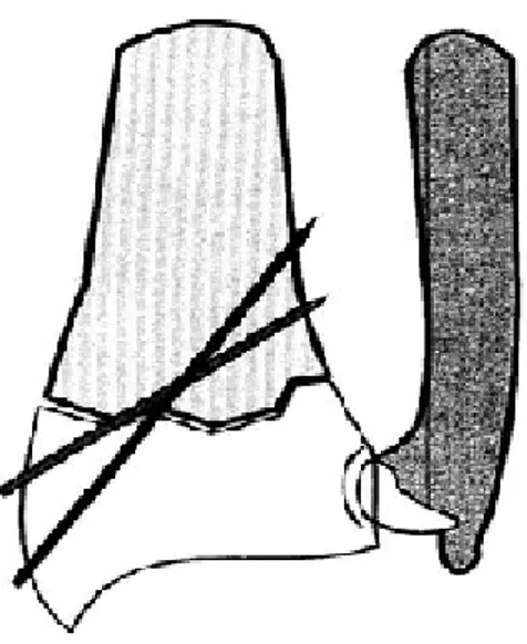 Figure 5 : le brochage classique deux broches divergentes sont introduites dans la styloïde  radiale (9) 