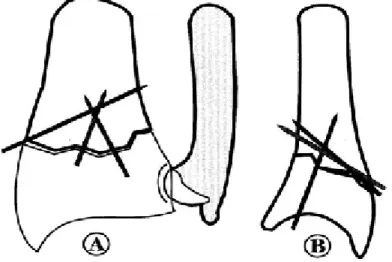 Figure 6 : Le brochage intra-focal de kapandjy (9) 