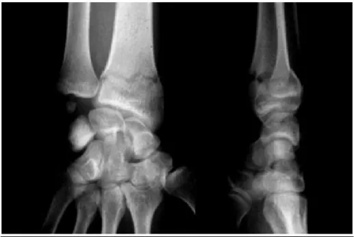 Figure n° 7: fracture de Pouteau Colles non déplacée traitée orthopédiquement 