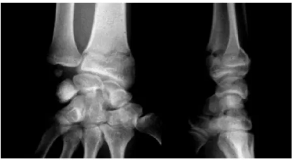 Figure  n°8 : fracture de Pouteau colles peu déplacée traitée orthopédiquement 