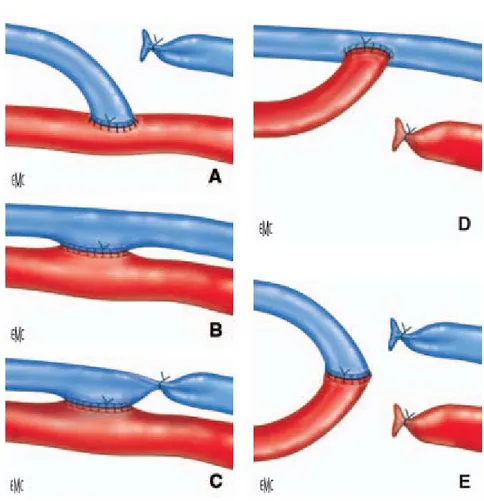 Figure 6 : Variantes anastomotiques d’une fistule radiale  A.  Anastomose latéro-terminale de la veine sur l’artère 