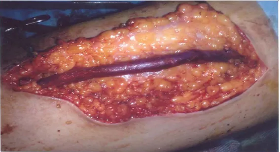 Figure 9: Photographie  per-opératoire d’une superficialisation de la veine basilique  Dr M