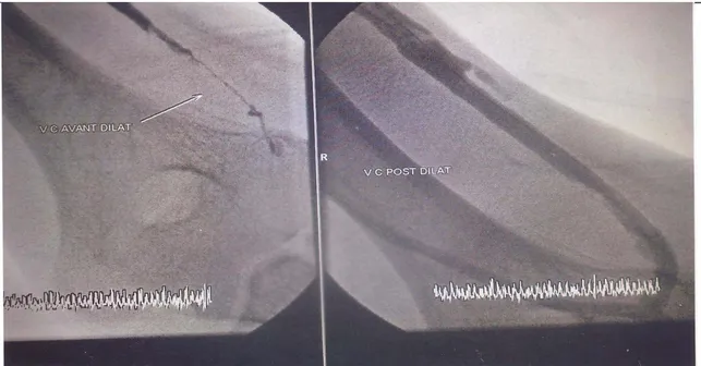 Figure 14 : Sténose huméro-céphalique juxta-anastomotique avant et après dilatation  Photographie de Dr M