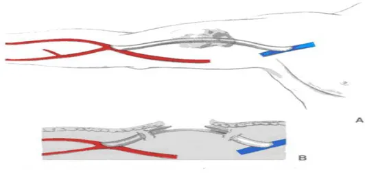 Figure 15 : Exclusion drainage pour infection sur point de ponction d’un PAV 