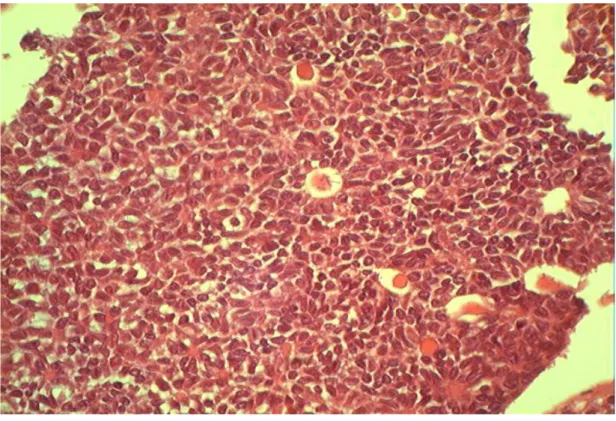 Figure 9 : aspect microscopique de la tumeur de la granulosa adulte. 