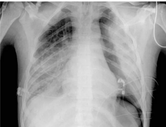 Fig. 6 : Radio thorax d’un patient qui a présenté un SDRA au cours du paludisme grave