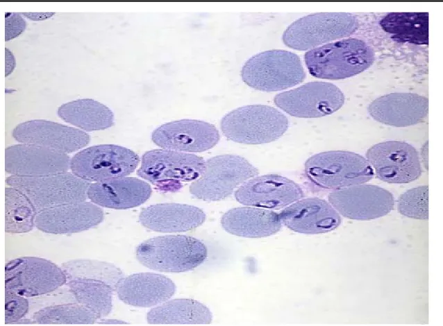 Fig. 7 : Frottis sanguin mettant en évidence Plasmodium falciparum intra érythrocytaire [92]