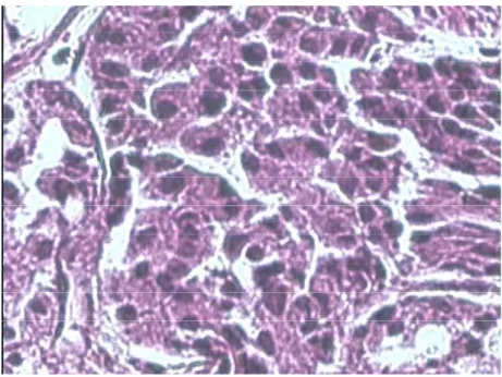 Figure 12 : Carcinome endocrine bien différencié de l’estomac (HEx400) : Les cellules tumorales  sont munies d’un noyau régulier et hyperchromatique 