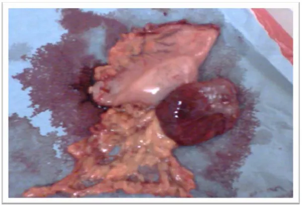 Figure 15 : gastrectomie polaire inférieure pour tumeur stromale de la petite courbure 
