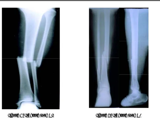 Figure 7: Fracture type A3 Figure 8: Fracture type A1 