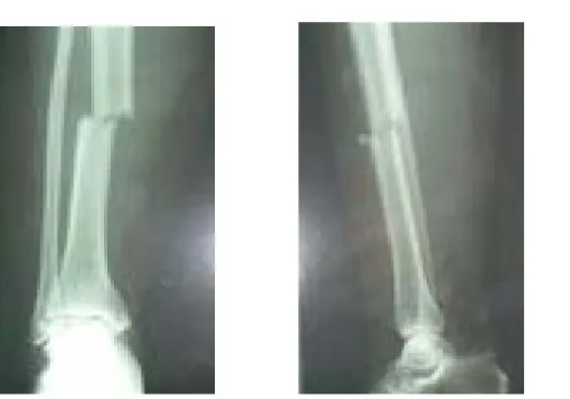 Figure :Fracture de jambe à fibula intacte 