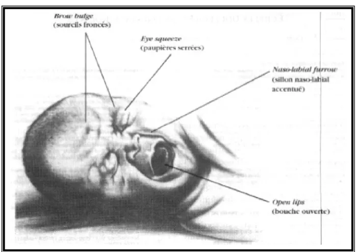 Fig. 12 : L’échelle NFCS évalue la douleur aiguë chez le nouveau-né jusqu’à 18 mois, en  décrivant l’expression faciale du nouveau-né douloureux [21] 