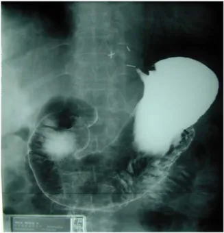 Figure 10 : Image radiologique d’un estomac normal avec un produit de contraste 
