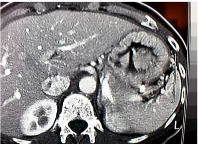 Figure 11 : Image tomodensitométrique montrant les rapports de la face antérieure de l’estomac                                    