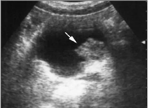 Fig 2a : image échographique montrant une tumeur bourgeonnante de la paroi  vésicale 