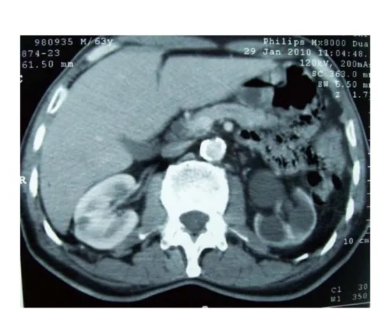 Figure 4: Retentissement de la tumeur vésicale sur le haut appareil urinaire: hydronéphrose  droite 
