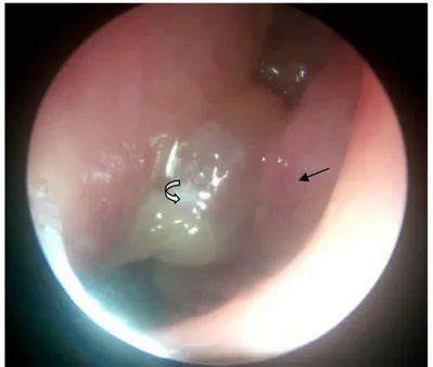 Figure 8 : polype au niveau de la fosse nasale gauche classé stade III 