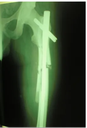 Figure 21 : Radiographie d’une FDF du 1/3 sup traitée par un clou gamma long 