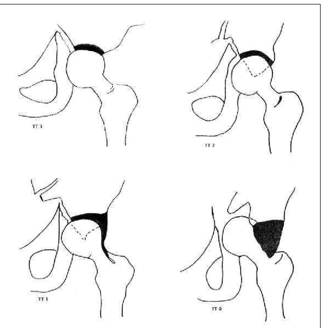 Figure 8:::: Congruence tête-toit "TT" 