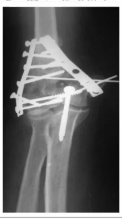 Figure 18 : Rx du coude face : ostéosynthèse par 2 plaques  +vissage+embrochage de l’épithrochlée