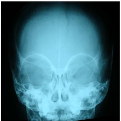 Fig 5 :  :  : radiographie du crâne de face d’une trigonocéphalie (obs n° 2) :  radiographie du crâne de face d’une trigonocéphalie (obs n° 2) radiographie du crâne de face d’une trigonocéphalie (obs n° 2) radiographie du crâne de face d’une trigonocéphalie (obs n° 2) 