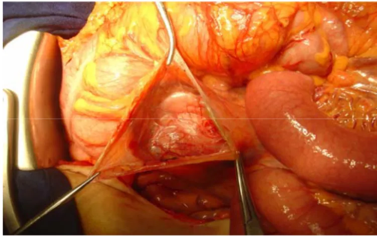 Figure 7: (Observation nº 1). Vue opératoire : abord trans-péritonéale de la tumeur. 