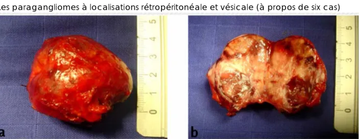 Figure 9: (Observation nº 1). (a) Prolifération des cellules chromaffines disposées en îlots après  coloration à l’HE