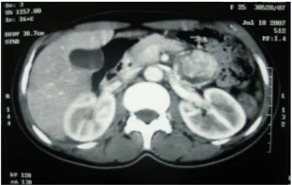 Figure 10: (Observation nº 2).  TDM abdominale : Masse rétro péritonéale, pré-rénale gauche,  mesurant 5/5cm, de densité tissulaire, hétérogène, se rehaussant après injection de produit de 