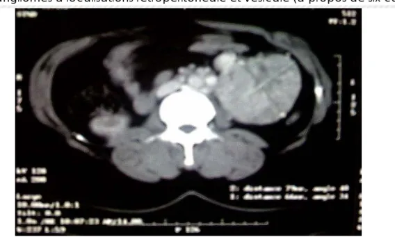 Figure 12: (Observation nº 3). Tomodensitométrie abdominale qui montre une masse tumorale  rétropéritonéale