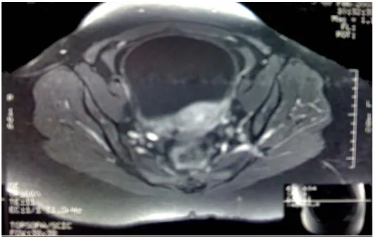 Figure 13 : (Observation nº 4). Imagerie par résonance magnétique (IRM) pelvienne : processus  tumoral trigonal mesurant 20/10 mm, hyperintense en pondération T2