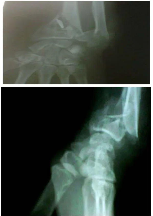 Figure  n° 12 : Fractures communitives chez un patient âgé de 32 ans suite à un AVP 