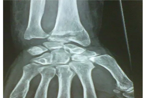 Figure n° 28 : Radiographie de face du poignet montrant une fracture articulaire  de type « T à trait sagittal» selon CASTAING et GRUMILLIER 