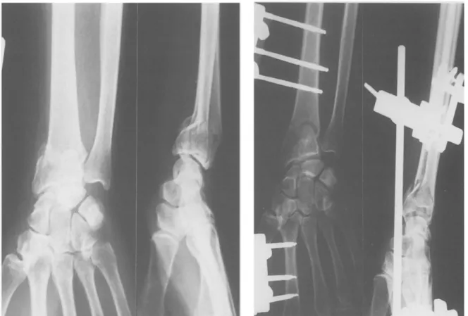 Figure  n°34 : Radiographie  de face et profil du poignet montrant une fracture  communitive de l’E.I.R selon CASTAING(4) et GRUMILLIER (12) traité par un 